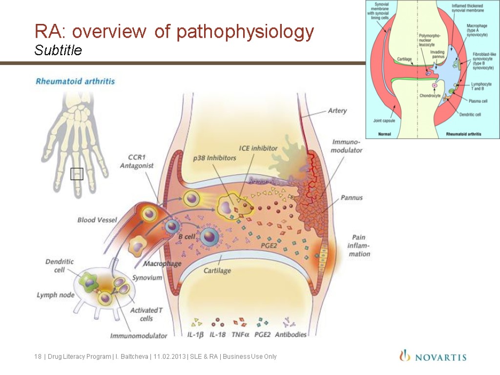 RA: overview of pathophysiology Subtitle 18 | Drug Literacy Program | I. Baltcheva |